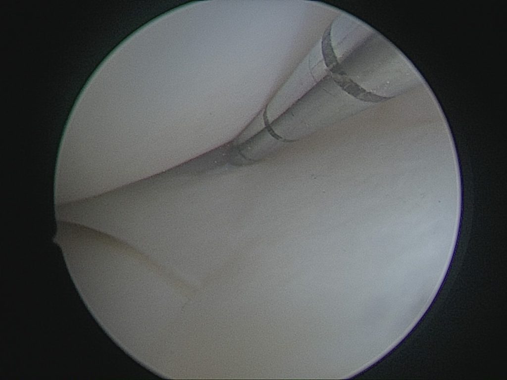 Sutt meniscus2016-04-20_090614_IMG0001